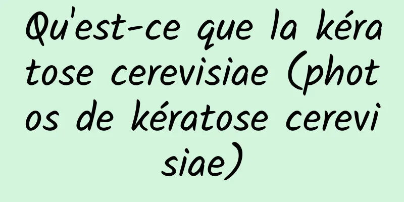 Qu'est-ce que la kératose cerevisiae (photos de kératose cerevisiae)